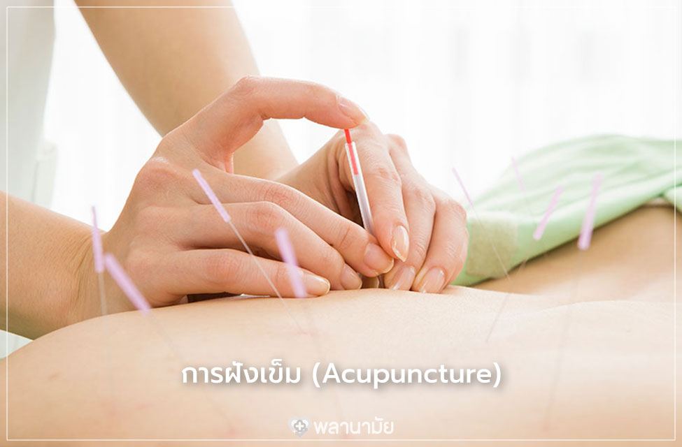 การฝังเข็ม แพทย์ทางเลือก การแพทย์แผนจีน Care Mind Life การฝังเข็ม แพทย์ทางเลือก การแพทย์แผนจีน