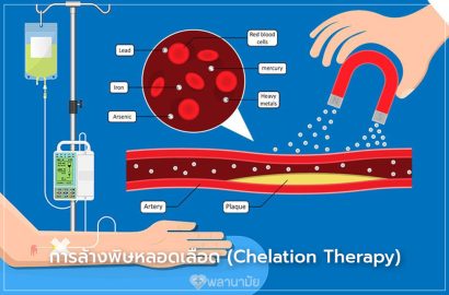คีเลชั่นบำบัด Chelation Therapy การล้างพิษหลอดเลือด เทคโนโลยีการแพทย์