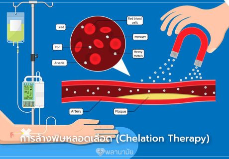 คีเลชั่นบำบัด (Chelation Therapy) การล้างพิษหลอดเลือด เทคโนโลยีการแพทย์