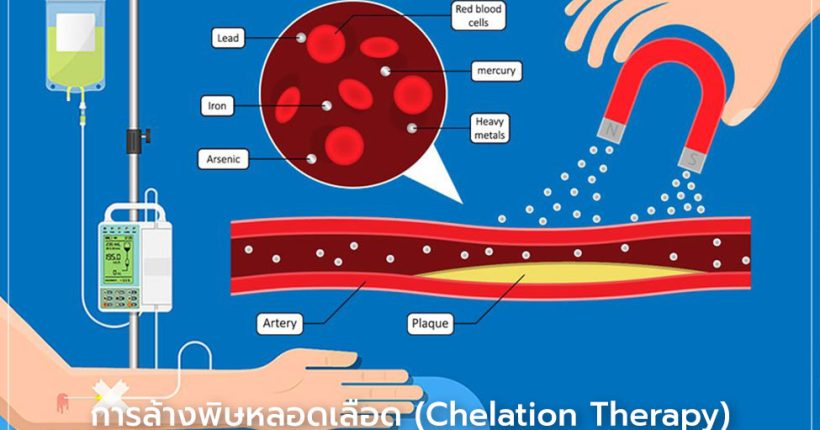 คีเลชั่นบำบัด (Chelation Therapy) การล้างพิษหลอดเลือด เทคโนโลยีการแพทย์