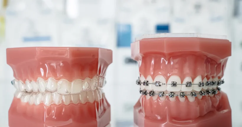 จัดฟันที่ไหนดี