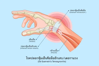 โรคปลอกหุ้มเอ็นข้อมืออักเสบ โรคเดอกาแวง De Quervain Tenosynovitis
