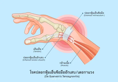 โรคปลอกหุ้มเอ็นข้อมืออักเสบ โรคเดอกาแวง De Quervain Tenosynovitis