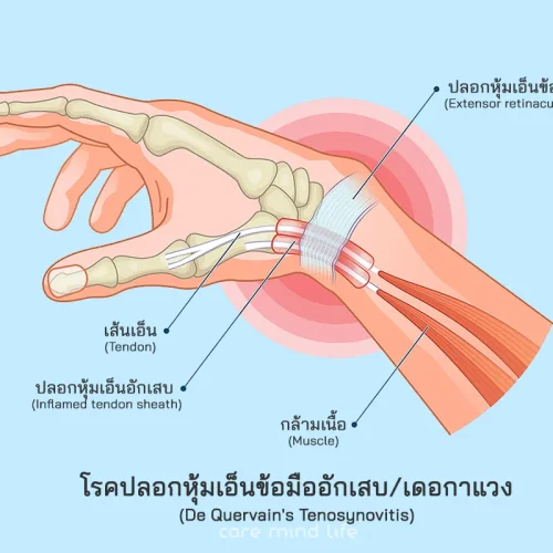 โรคปลอกหุ้มเอ็นข้อมืออักเสบ โรคเดอกาแวง De Quervain Tenosynovitis