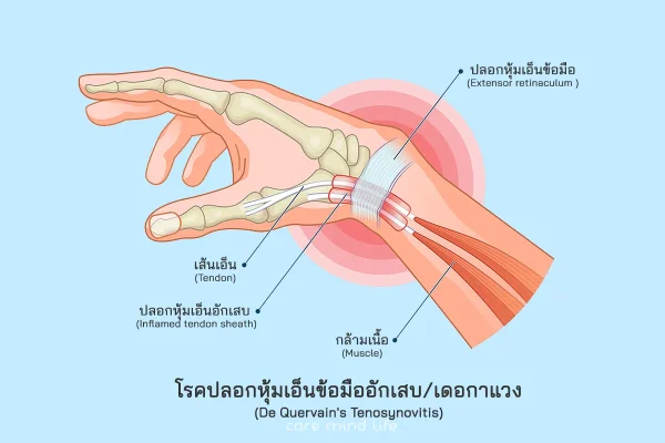 โรคปลอกหุ้มเอ็นข้อมืออักเสบ โรคเดอกาแวง De Quervain Tenosynovitis