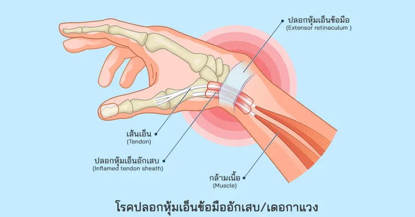 โรคปลอกหุ้มเอ็นข้อมืออักเสบ โรคเดอกาแวง De Quervain Tenosynovitis