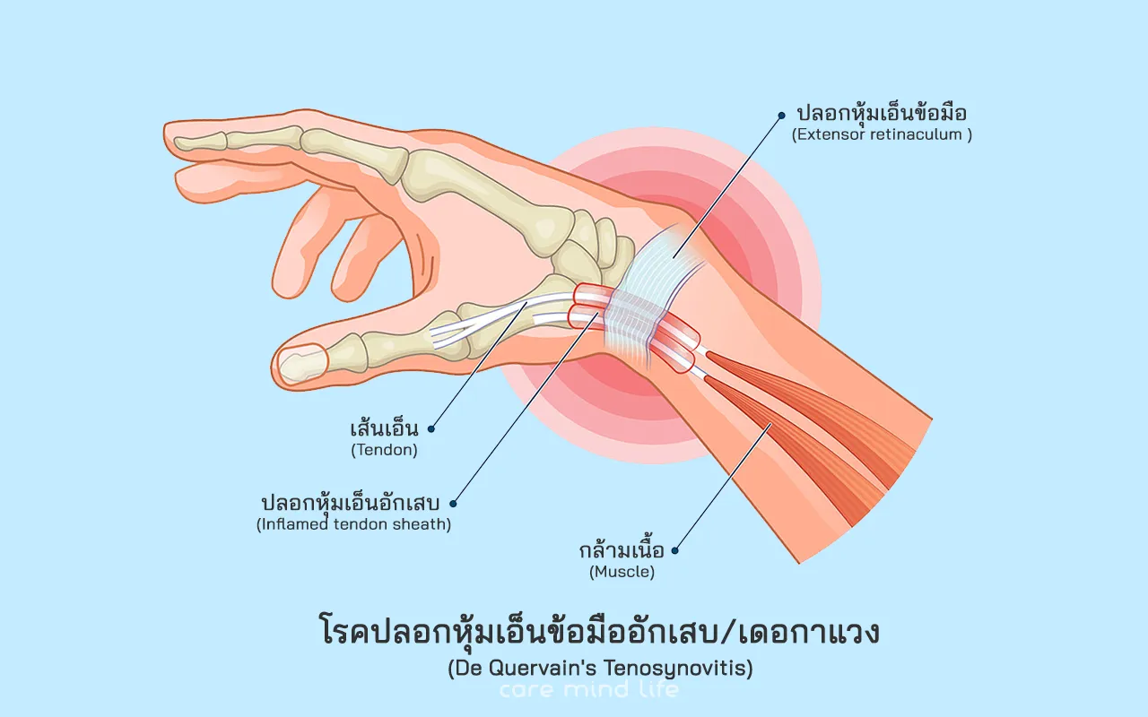 โรคปลอกหุ้มเอ็นข้อมืออักเสบ โรคเดอกาแวง De Quervain Tenosynovitis