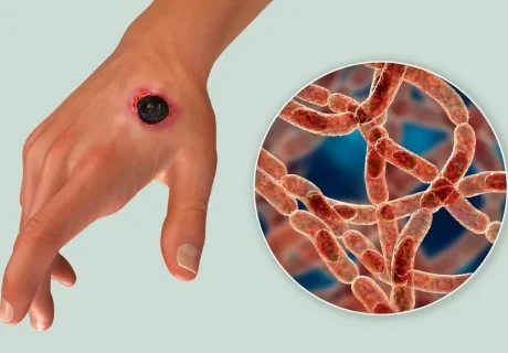 โรคแอนแทรกซ์ (Anthrax) ความเสี่ยงจากการบริโภคเนื้อวัวดิบ