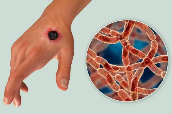 โรคแอนแทรกซ์ (Anthrax) ความเสี่ยงจากการบริโภคเนื้อวัวดิบ