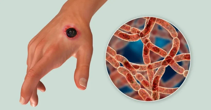 โรคแอนแทรกซ์ (Anthrax) ความเสี่ยงจากการบริโภคเนื้อวัวดิบ